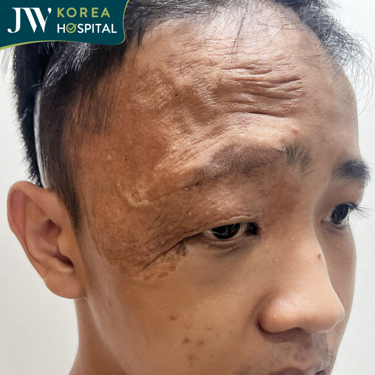 Kết quả thăm khám cho thấy bệnh nhân bị bướu máu tồn lưu, da dư vùng trán và sụp mi độ 2–3