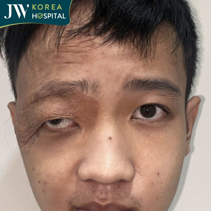 Bệnh nhân được xây dựng kế hoạch phẫu thuật tạo hình phục hồi sau di chứng u máu bẩm sinh