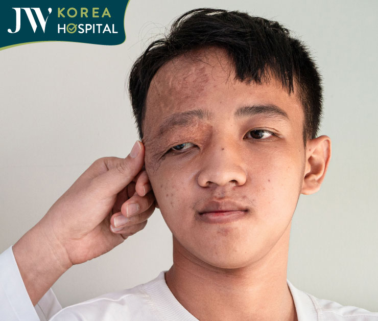 Bệnh nhân trước phẫu thuật với vùng trán nhăn, sụp mí do di chứng u máu bẩm sinh