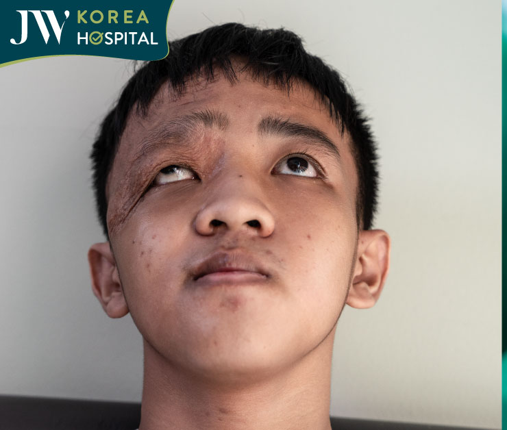 Gương mặt biến đổi do di chứng u máu bẩm sinh trước khi được can thiệp phẫu thuật.