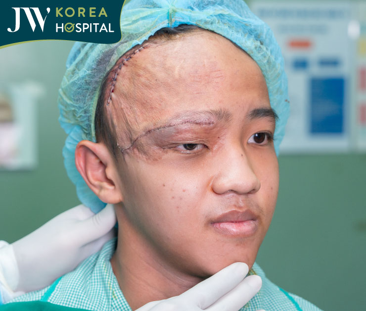 Vùng mắt phải của bệnh nhân không còn bị da dư che phủ sau ca phẫu thuật tại Bệnh viện JW