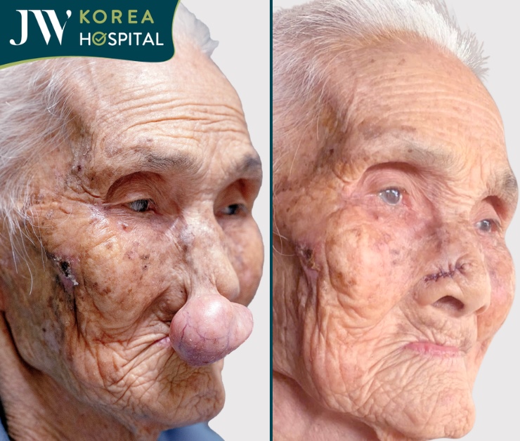 Cụ Lê Thị Khoan 100 tuổi bị khối u chèn ép đường thở hơn 30 năm