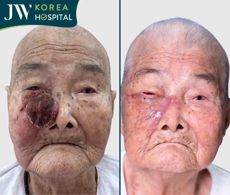 Cụ Nguyễn Thị Thơi 93 tuổi mắc khối u chèn ép đường thở