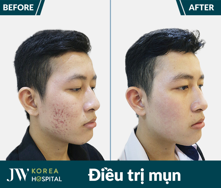 Hình ảnh trước và sau của khách hàng sau liệu trình điều trị mụn tại bệnh viện JW