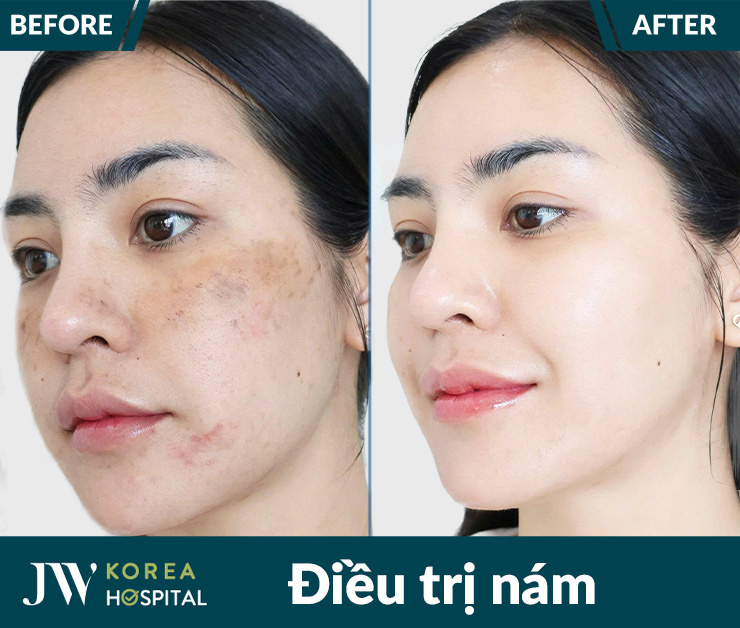 Hình ảnh trước và sau điều trị nám của khách hàng tại Bệnh viện JW