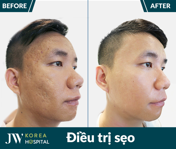 Hình ảnh trước sau của khách hàng sau liệu trình điều trị sẹo tại bệnh viện JW