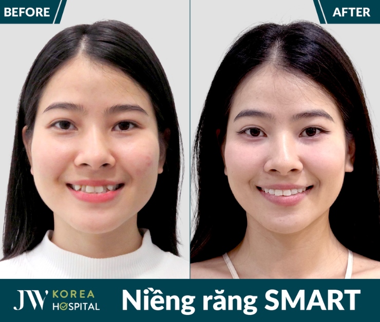 Kết quả trước và sau Niềng răng SMART tại Bệnh viện JW