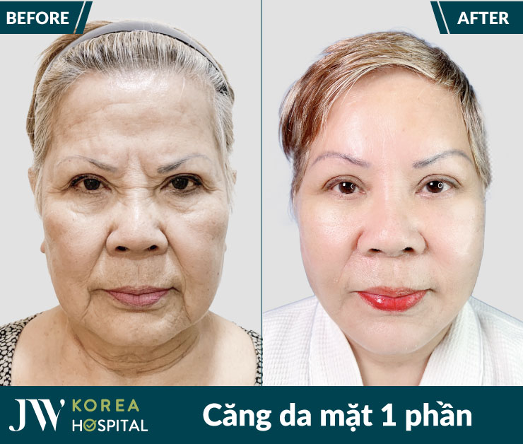 ket qua truoc va sau cang da mat 1 phan tai benh vien jw