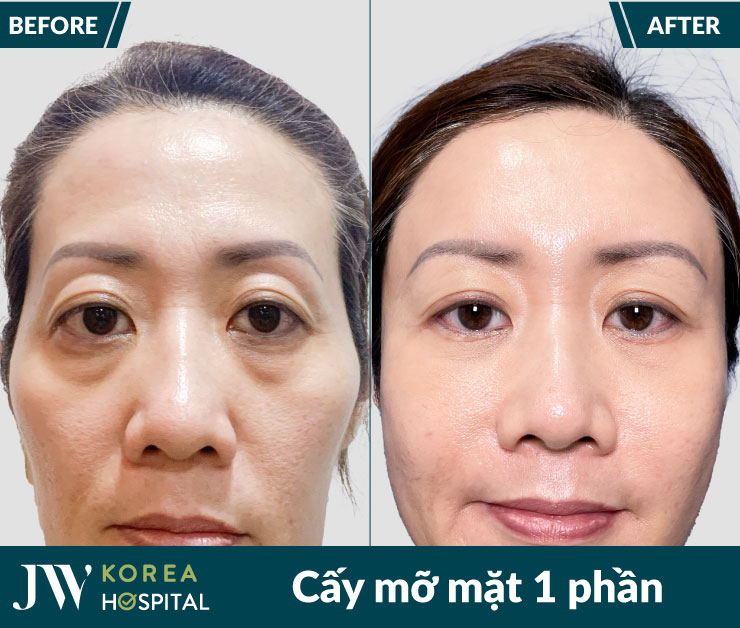 ket qua truoc va sau cay mo mat 1 phan tai benh vien jw