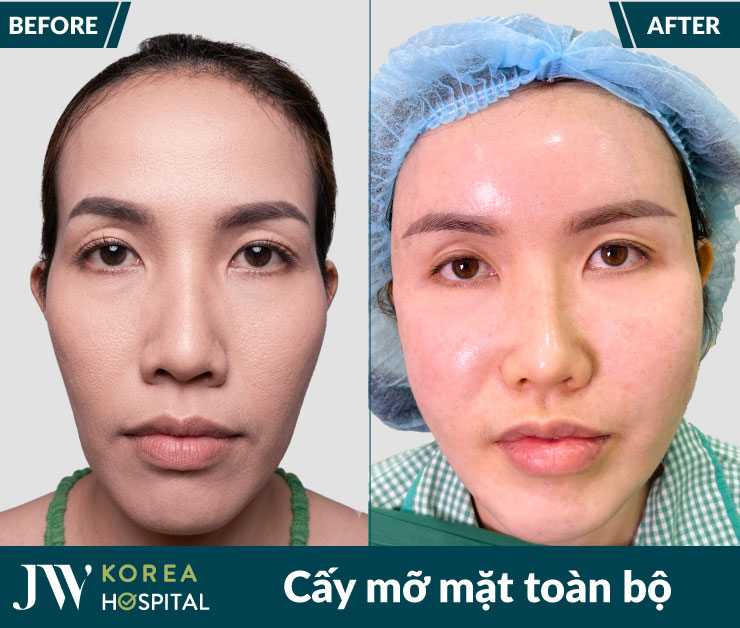 ket qua truoc va sau cay mo mat toan bo tai benh vien jw