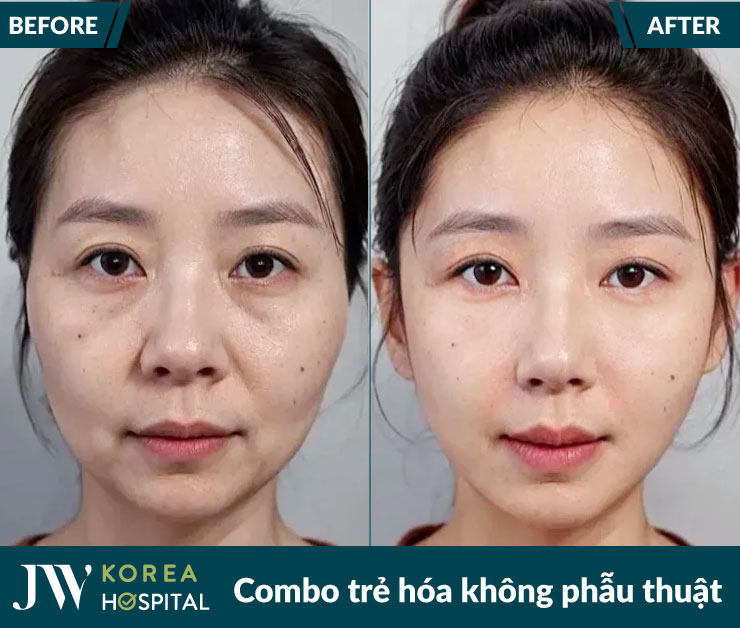ket qua truoc va sau combo tre hoa mat khong phau thuat tai benh vien jw