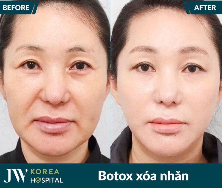 ket qua truoc va sau lieu trinh botox xoa nhan tai benh vien jw