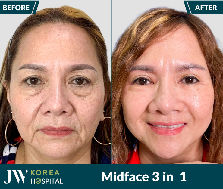 ket qua truoc va sau midface 3 in 1 tai benh vien jw