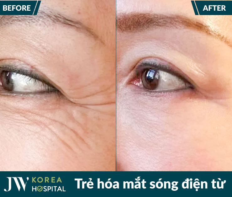 ket qua truoc va sau tre hoa mat bang song dien tu rf