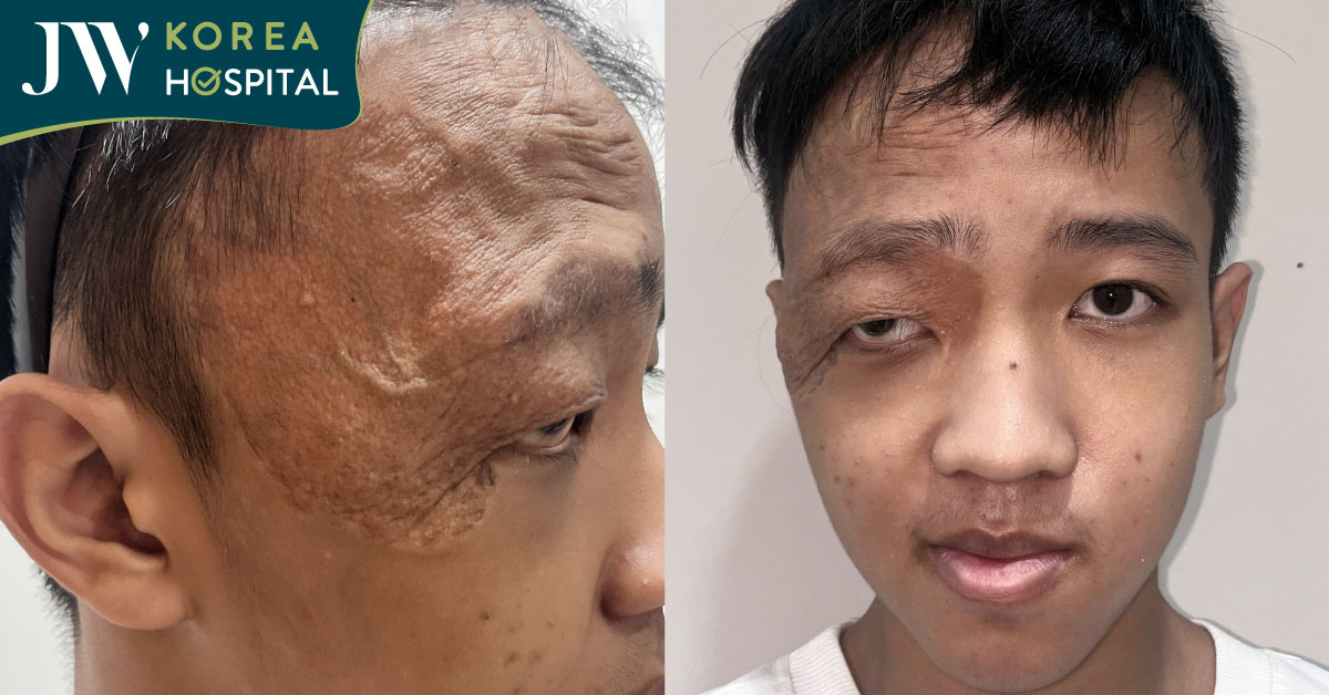 mang di chứng u máu bẩm sinh, nam sinh 16 tuổi mang gương mặt khác lạ