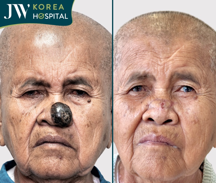 Sư bà Khơ-me 80 tuổi bị mắc khối u ác tính ở mũi